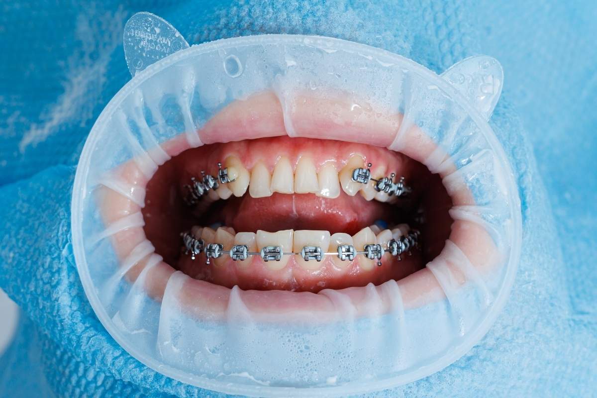teeth-with-braces-dental-checkup