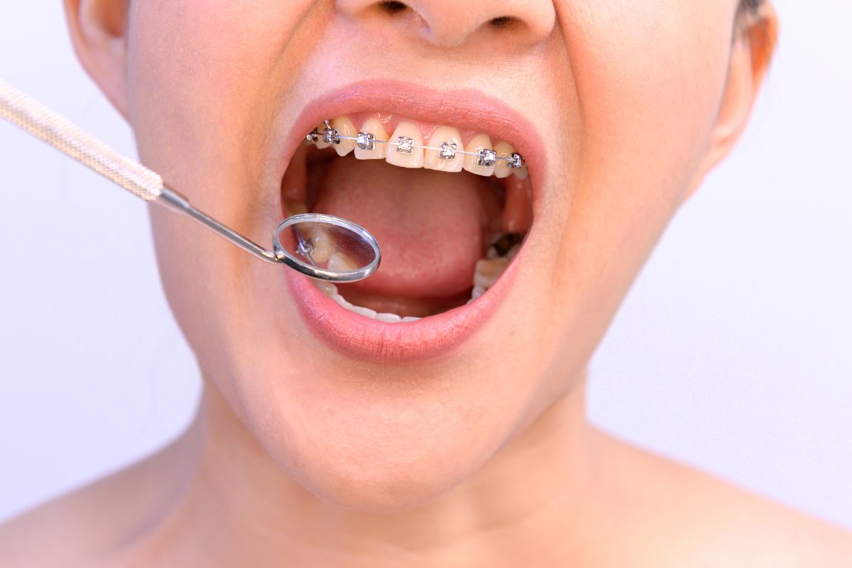 benefits of orthodontic treatment